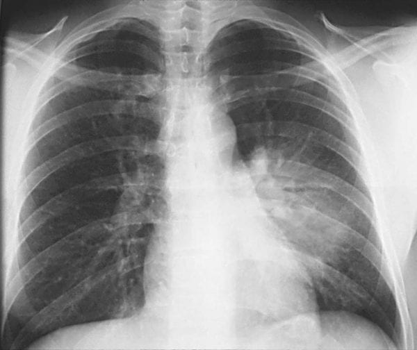 Hospital-Acquired Pneumonia Surveillance—an Unmet Need - Global Health ...