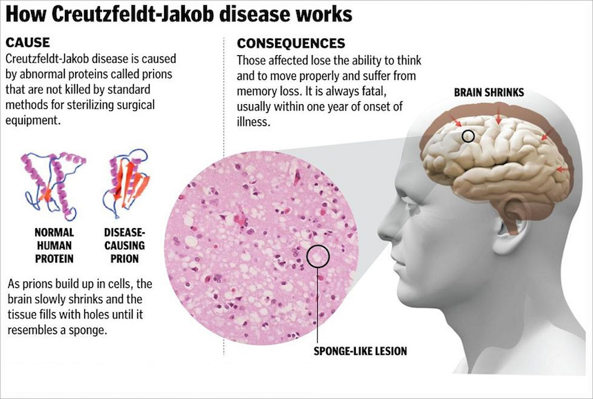 What Is The Cause Of Creutzfeldt Jakob Disease